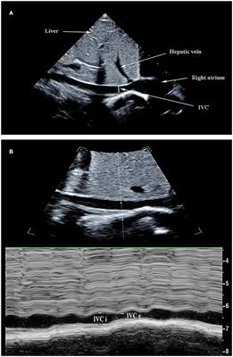 Predictive Value of the Respiratory Variation in Inferior Vena Cava Diameter for Ventilated Children With Septic Shock